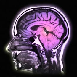 MRI brain scan