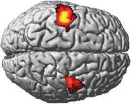 Brain striatums